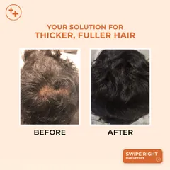 This before and after image showcases the effectiveness of our GFC/PRP treatments. By stimulating dormant hair follicles, we can achieve a fuller, denser appearance and combat androgenic alopecia, or pattern hair loss.