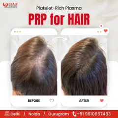 This before and after comparison clearly shows the effectiveness of PRP for hair. The "after" photo reveals a significant increase in hair volume and scalp coverage, demonstrating a successful reduction in hair thinning.