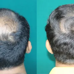 The crown area, or vertex, is a common area of concern. Here, you can see how I successfully filled in a significant bald patch on the crown. My technique ensures the hair grows in the correct direction, mimicking the natural whorl pattern for an undetectable result.