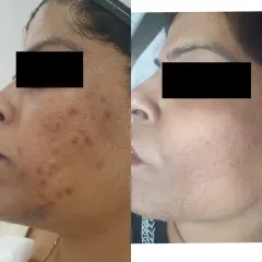 Here you can see a dramatic improvement in post-inflammatory hyperpigmentation (PIH), where dark spots from old acne have faded to reveal a clearer, even complexion.