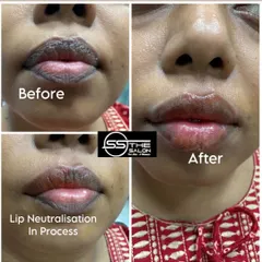 Here you can see the transformative power of my Lip Neutralisation service. This before and after collage shows how I correct dark pigmentation in just one session, resulting in lighter, more evenly toned lips, creating a perfect base for any lip color or a natural look.