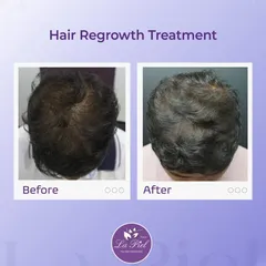 Here you can see the results of a targeted hair regrowth treatment for male pattern thinning. We successfully increased hair volume and scalp coverage, leading to a fuller and healthier appearance.