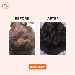This is the kind of transformation that is possible with a consistent, personalized hair restoration plan. This patient's results show a significant increase in hair density and scalp coverage, restoring not just their hair, but their confidence.