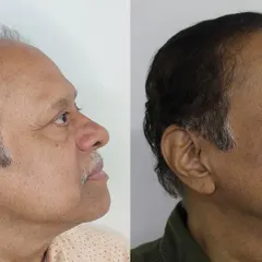 A side view of the same 64-year-old patient. The new hair growth has dramatically changed his profile, giving him a fuller and more youthful look.