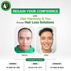 A picture is worth a thousand words, and this before and after comparison says it all. Notice the natural-looking hairline and the incredible boost in confidence, evident in his smile. This is the kind of life-changing result I strive for with every client.