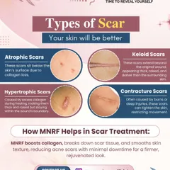 Understanding your scar is the first step to treating it. This educational graphic explains the different types of scars, such as atrophic, keloid, and hypertrophic, and details how our MNRF treatment helps by boosting collagen and breaking down scar tissue.