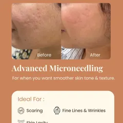 This before-and-after shows the power of advanced microneedling for improving skin tone and texture. It's an ideal treatment for scarring, fine lines, and skin laxity.