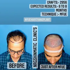 This image shows a client before the procedure and immediately after the placement of 2956 grafts using the MFUE technique. You can see the clean, dense placement which is the foundation for great results in 6 to 8 months.