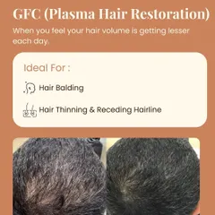 The proof is in the results. This patient saw a significant increase in hair density and coverage after GFC sessions at our clinic. We focus on creating personalized treatment plans because hair restoration is a journey, and results like these are our shared goal.