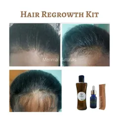 This is a wonderful six-month progress photo from a customer using my Hair Regrowth Kit, which includes the oil, serum, and a neem comb. It shows how steady use can lead to visible hair regrowth and a fuller hairline.