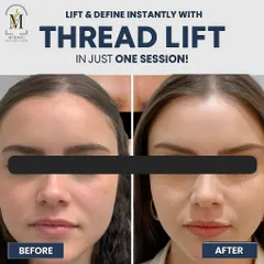 A thread lift offers a fantastic non-surgical option for lifting and tightening the skin. You can see the immediate improvement in facial contours and reduction in sagging in this before and after result.