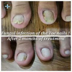 This before-and-after image shows the significant improvement in a fungal toenail infection after just two months of proper treatment. Timely intervention is key, especially for diabetic patients, to prevent complications and restore nail health.