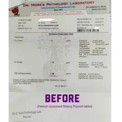 Before: This patient's lab report from 2018 shows a TSH level of 7.58, indicating hypothyroidism, even while taking a 50mcg thyroid tablet.