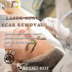 Laser acne scar removal is a safe and effective procedure for most skin types. It works by targeting the damaged tissue to reduce scar depth and texture while boosting collagen production for healthier, plumper skin from within.