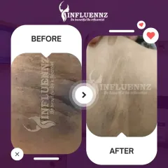 Here is another example of the effectiveness of my underarm brightening solutions. The treatment successfully addressed the dark, textured skin, resulting in a smoother and brighter appearance.