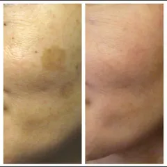 This before and after image shows the successful treatment of a stubborn patch of hyperpigmentation. Using a targeted approach, I was able to significantly lighten the dark spot and even out the patient's skin tone.