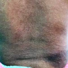 This is Miliaria Crystallina, also known as heat rash or prickly heat, which is common in summer, especially in children. It's caused by blocked sweat ducts and can be managed by wearing loose cotton clothes and applying a light moisturizer.