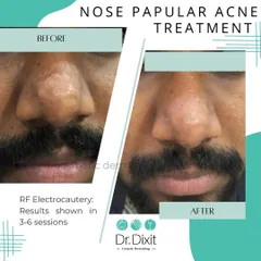 This is a real result from treating papular acne on the nose using RF Electrocautery. This before and after image shows the significant improvement possible with the right procedure. This treatment effectively reduces lesions and improves skin texture over a few sessions.