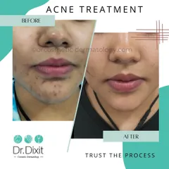 This patient's journey shows how a consistent treatment plan for active acne can prevent future scarring. Trusting the process with prescribed medications and in-clinic procedures leads to clear, healthy skin.