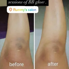 BB Glow isn't just for the face. Here, you can see a noticeable lightening of pigmentation on the knees after just two sessions, demonstrating how the treatment can even out skin tone on the body.