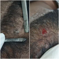 This patient came to us for a bothersome wart on their scalp. The side-by-side image shows the wart and the clean area immediately after it was removed by our team.