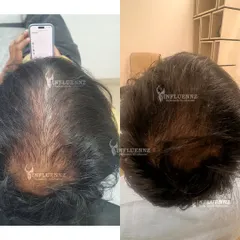 This is the kind of visible result we can achieve. This client's before and after photos show a significant increase in hair density and scalp coverage after completing their personalized hair restoration plan. We focused on reactivating dormant follicles for natural, thicker regrowth.