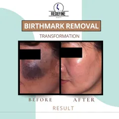 This powerful before-and-after image shows the transformation possible with birthmark removal treatments. The result is clearer skin and a huge boost in confidence for the client.