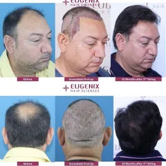 A detailed look at a patient's journey from before the procedure, to immediately post-op, and finally the 10-month result. This shows the healing process and the final, dense outcome from the back and side.