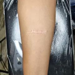 A clear 'before' photo of the surgical scar on the forearm prior to the tattoo.