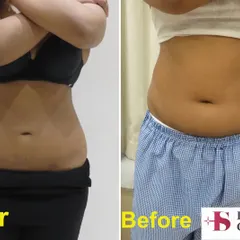 This before and after view from the front shows the result of abdominal liposuction. Notice the reduction in fullness around the waist and the more defined midsection. This procedure helps create a flatter stomach and a more streamlined silhouette.