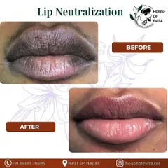 This is another successful Lip Neutralization. The "after" photo shows a significant reduction in hyperpigmentation and a beautifully balanced, natural pink tone.