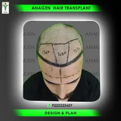 The first step is always design and planning. Here you can see how we map out the transplant area, calculating the exact number of grafts needed for each zone to create a balanced and natural look.