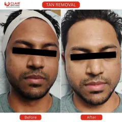 This is a clear example of our effective tan removal treatment. We help restore your skin's natural tone, reversing sun damage to reveal a brighter, healthier complexion. The process is quick, safe, and delivers visible results.