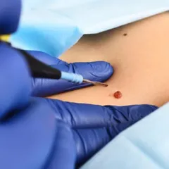 Here you can see the radiofrequency cautery technique in action for mole removal. This method is extremely precise, allowing me to target the growth without affecting the surrounding skin, which is key to minimizing scarring and ensuring a clean, aesthetic result.