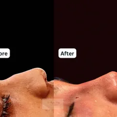 This patient felt her nose appeared too masculine due to a prominent dorsal hump. The after photo shows the immediate result of a rhinoplasty to create a softer, more feminine profile that is in harmony with her other facial features.