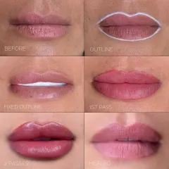 Achieving the perfect, natural-looking lips is a process I take very seriously. This image shows the step-by-step journey of a lip filler treatment, from the initial outline to the final healed result. My goal is always to enhance your natural shape for a balanced and beautiful smile, never to make it look 'done'.