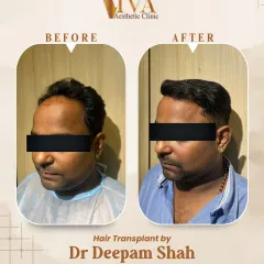 A side profile view of the same Grade 3 hair transplant. Notice how the new hairline frames the face naturally, blending seamlessly with the temple hair for a result that doesn't look artificial.