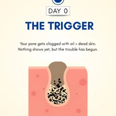 Day 0: The process begins when a pore gets clogged with oil and dead skin cells. At this stage, nothing is visible on the surface, but the foundation for a pimple has been laid.