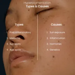 This visual breaks down the common types of hyperpigmentation, including post-inflammatory marks, melasma, and sun spots, alongside their primary causes like sun exposure and hormonal shifts.
