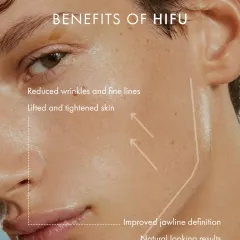 High-Intensity Focused Ultrasound, or HIFU, is one of my preferred methods for non-surgical skin tightening. This image illustrates its key benefits: reducing wrinkles, lifting sagging skin, and improving jawline definition for natural-looking results.