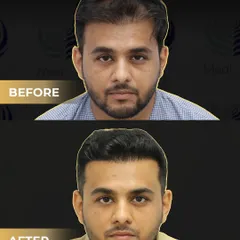 Another successful corrective transplant. The patient came to us with an unsatisfactory result from another clinic. We used 3500 grafts with our Perfect-i technique to restore a natural aesthetic and give him the result he deserved.