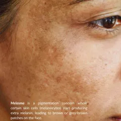 Melasma is a common pigmentation concern where melanocytes produce extra melanin, leading to brown or grey-brown patches. Understanding its cause is the first step to effective treatment.