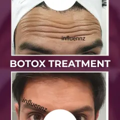 Botox isn't just for women. Here is an example of a male patient with a significant reduction in forehead lines, resulting in a more rested and youthful look.