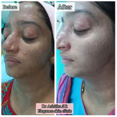 This before and after photo shows a significant reduction in hyperpigmentation. We achieved this with a carefully planned treatment protocol, demonstrating that professional guidance is key for safe and effective results.