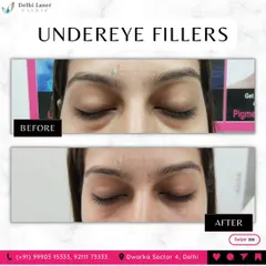 Hollow or dark under-eyes can make you look tired. This before and after shows how under-eye fillers can restore volume, reduce shadowing, and create a brighter, more rested appearance.