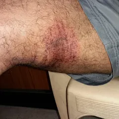 A closer look at the marks left by an equipped suit. This is a badge of honor in the world of geared powerlifting. It is not for everyone.
