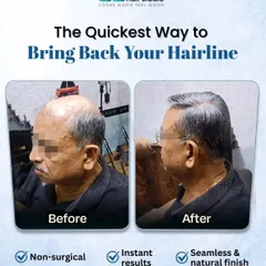 For men with a receding hairline, our hair replacement systems offer an instant fix. This transformation shows a seamless and natural finish, restoring a more youthful frame to the face.