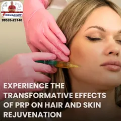 This image shows a Platelet-Rich Plasma (PRP) treatment in progress. A fine needle is used to deliver the PRP, derived from your own blood, into the skin to stimulate collagen and promote natural healing and rejuvenation from within.