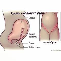 Round ligament pain is a common sharp pain felt in the lower belly or groin. This diagram shows where the ligaments are and why they stretch, causing discomfort as your uterus grows.
