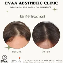 A clear before and after view of a client's scalp, demonstrating a visible reduction in the parting width and improved hair thickness. Our Hair PRP treatment effectively addresses diffuse hair thinning by stimulating dormant hair follicles.